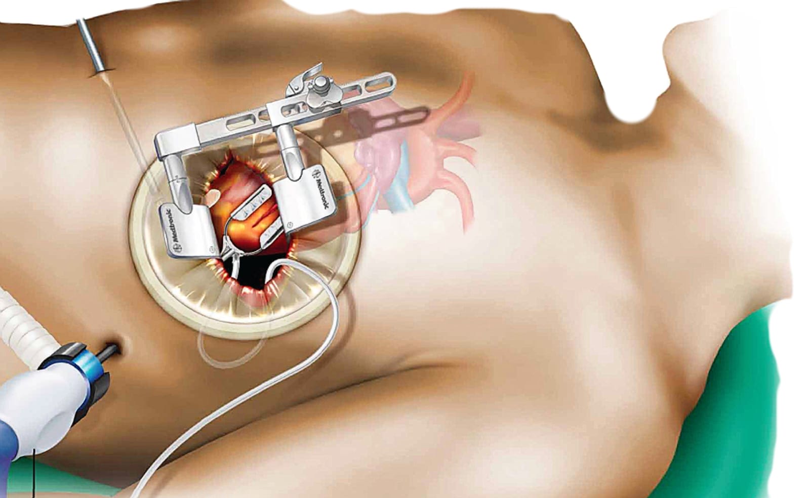 Minimally invasive cardiac surgery illustration